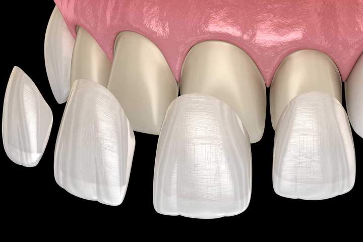 Une couronne pour des dents bien protégées !