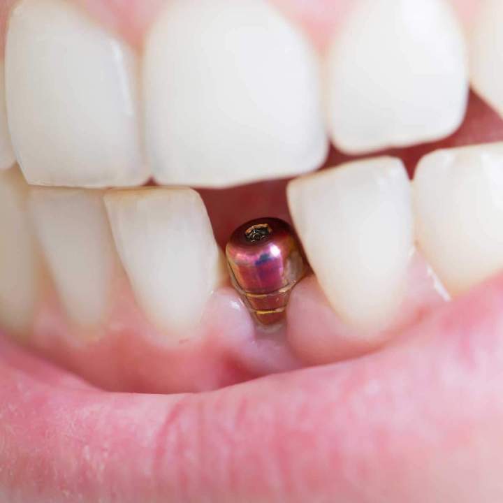 Mise en place d'implant dentaire Montréal