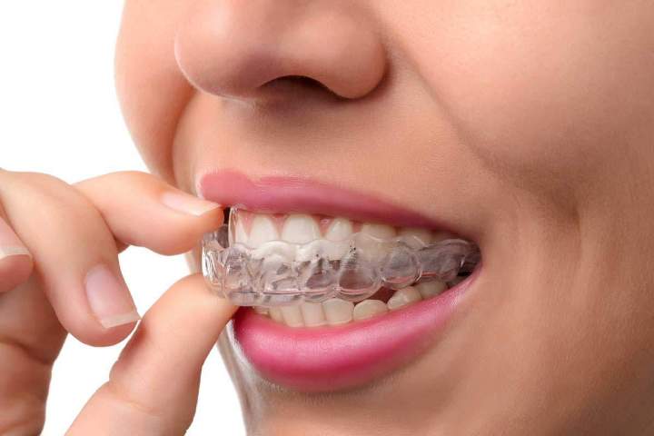 Blanchiment des dents Montréal