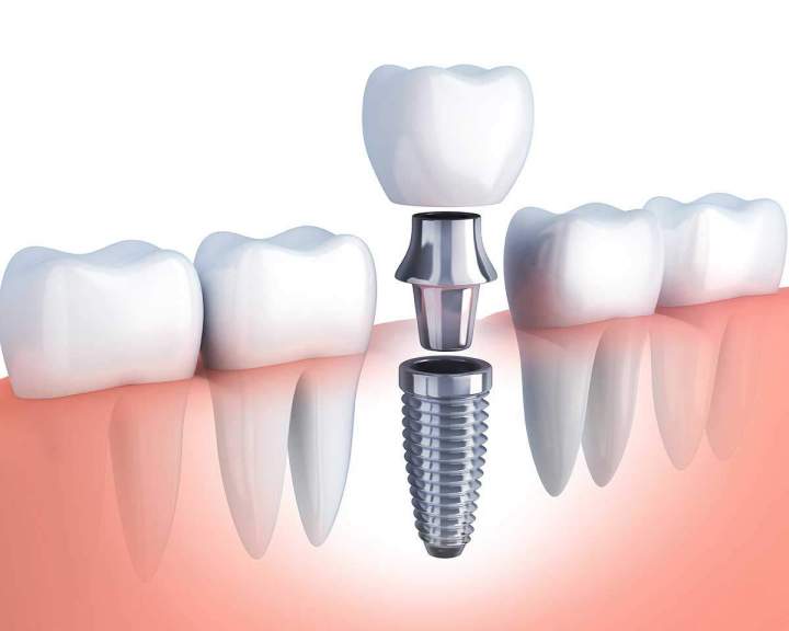 Implants dentaires Montréal