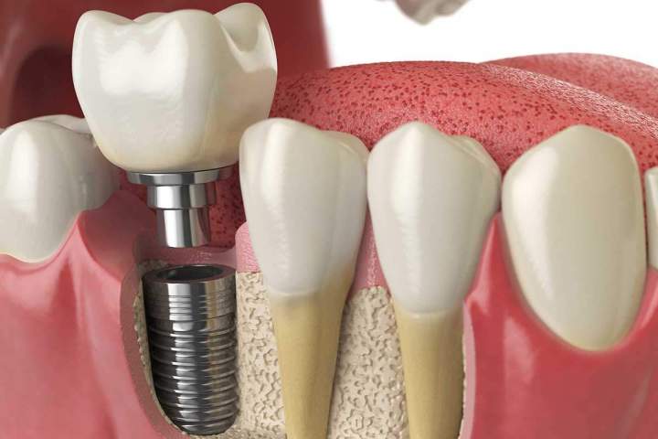 Un implant dentaire pour remplacer la racine !