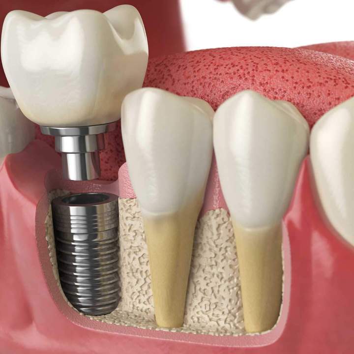Pose d'implant dentaire Montréal
