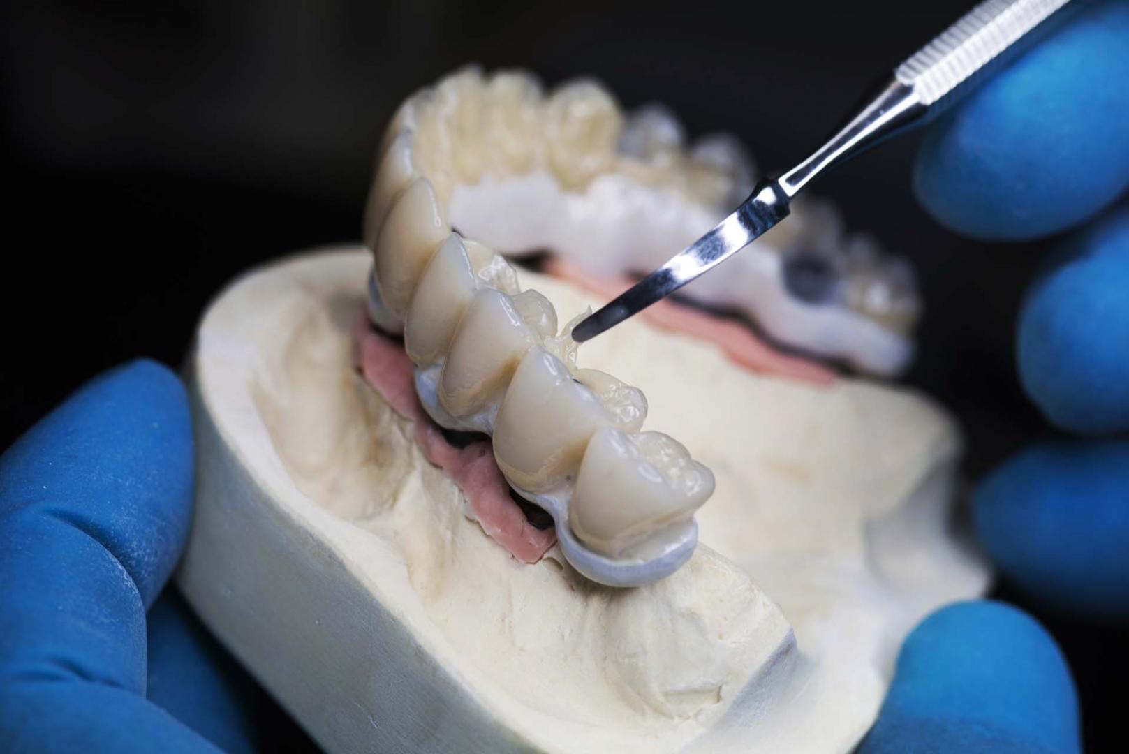 Dental crown Montreal