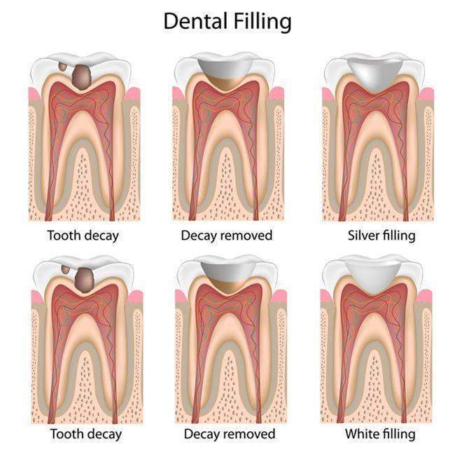 Dental Filling Montréal